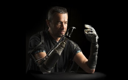 Amputees often feel disconnected from their bionic hands. AI could bridge the gap